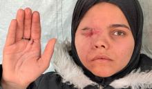ندى رحومة، طفلة (16 عامًا) نازحة بمنطقة الزوايدة وسط القطاع، ُأصيبت في غارة إسرائيلية قرب خيمة عائلتها في مدينة غزة وفقدت إحدى عينيها، وهي مُعرّضة لخطر فقدان البصر في العين الأخرى إذا لم تتلقَّ علاجًا طبيًا عاجلًا، 10 فبراير/شباط 2026. تصوير: محمد الأسود