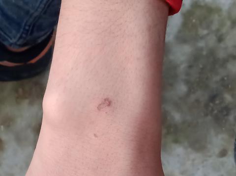 آثار حروق في يد طفل فلسطيني كان اعتقله الاحتلال وأطفأ محقق إسرائيلي سيجارته فيها خلال التحقيق معه