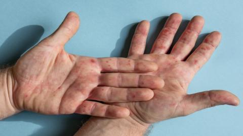 طفح جلدي وبقع حمراء وبثور على اليد. (shutterstock).jpeg