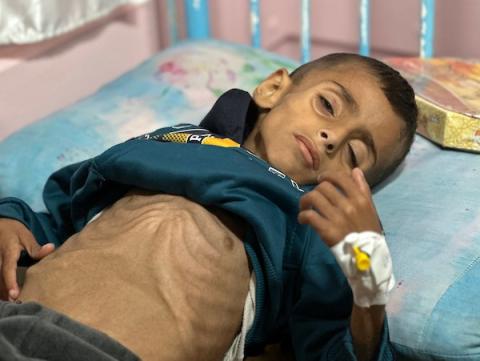 أطفال يتلقون الرعاية الصحية في مستشفى الرنتيسي بمدينة غزة بسبب سوء التغذية (11).jpg