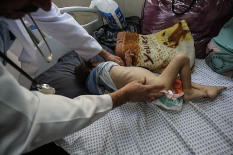 أطفال يتلقون الرعاية الصحية في مستشفى الرنتيسي بمدينة غزة بسبب سوء التغذية (8).jpg