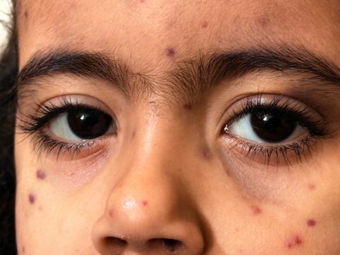 الطفلة مريم دياب تعاني من فشل نخاع العظم ونقص حاد في الصفائح الدموية وتنتظر نقلها إلى خارج قطاع غزة لإجراء عملية زرع نخاع عظم قد تنقذ حياتها، 15 فبراير/شباط 2026. تصوير: محمد الأسود
