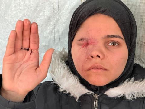 ندى رحومة، طفلة (16 عامًا) نازحة بمنطقة الزوايدة وسط القطاع، ُأصيبت في غارة إسرائيلية قرب خيمة عائلتها في مدينة غزة وفقدت إحدى عينيها، وهي مُعرّضة لخطر فقدان البصر في العين الأخرى إذا لم تتلقَّ علاجًا طبيًا عاجلًا، 10 فبراير/شباط 2026. تصوير: محمد الأسود