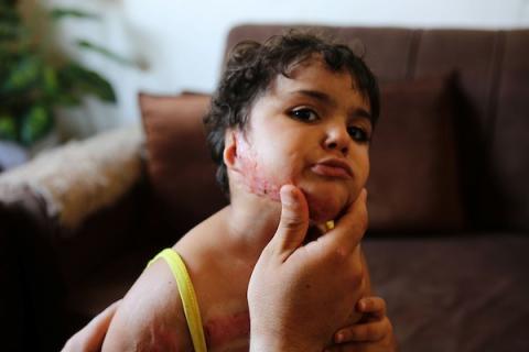 الطفلة الفلسطينية مسك أبو معزة، 3 سنوات، في مخيم الشاطئ بمدينة غزة، ولا تزال تعاني آثار حروق بالغة أُصيبت بها جراء غارة جوية إسرائيلية في ديسمبر/كانون الأول 2025، وسط نقص الأدوية والعلاج وانتظار فرصة للسفر لتلقي رعاية طبية. (تصوير: محمد صالحة)