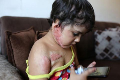 الطفلة الفلسطينية مسك أبو معزة، 3 سنوات، في مخيم الشاطئ بمدينة غزة، ولا تزال تعاني آثار حروق بالغة أُصيبت بها جراء غارة جوية إسرائيلية في ديسمبر/كانون الأول 2025. (تصوير: محمد صالحة)