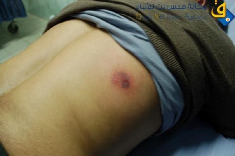 اصابة 7 شبان برصاص الاحتلال شرق جباليا