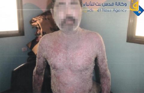 صور.." النجار"جسد يصهره مرض نادر "وعلاجه واسطة"!