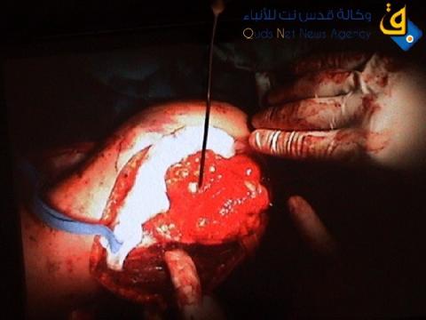 أطباء ينجحون في اجراء عمليتين جراحيتين مميزتين في مستشفى الشهيد كمال عدوان