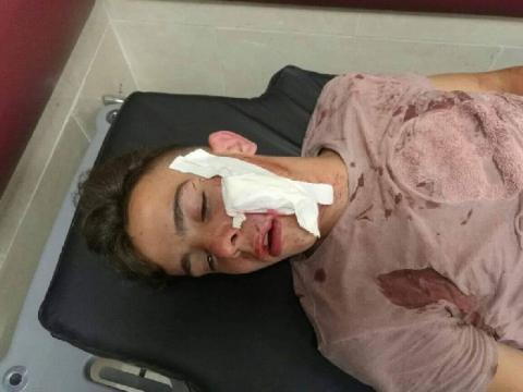 إصابة 9 مواطنين وصحفي برصاص الاحتلال في كفر قدوم