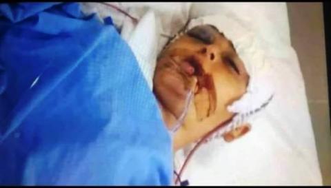تلف يصيب دماغ الطفل  اشتيوي جراء إصابته بطلق ناري إسرائيلي