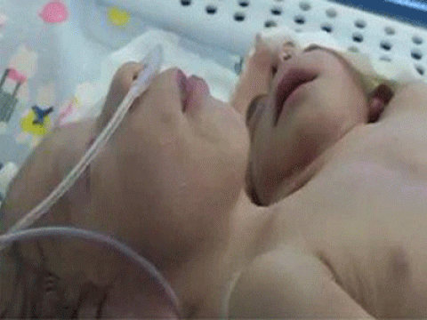 سيدة تلد طفلاً برأسين وقلبين فى مصر  بعد تأخر إنجاب لمدة 5 سنوات