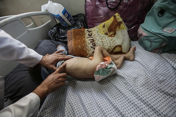 أطفال يتلقون الرعاية الصحية في مستشفى الرنتيسي بمدينة غزة بسبب سوء التغذية (5).jpg