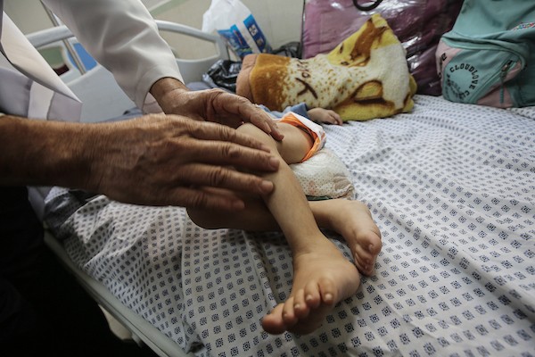 أطفال يتلقون الرعاية الصحية في مستشفى الرنتيسي بمدينة غزة بسبب سوء التغذية (6).jpg