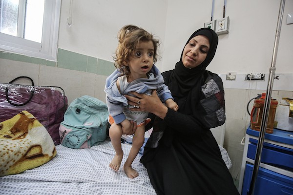 أطفال يتلقون الرعاية الصحية في مستشفى الرنتيسي بمدينة غزة بسبب سوء التغذية (3).jpg