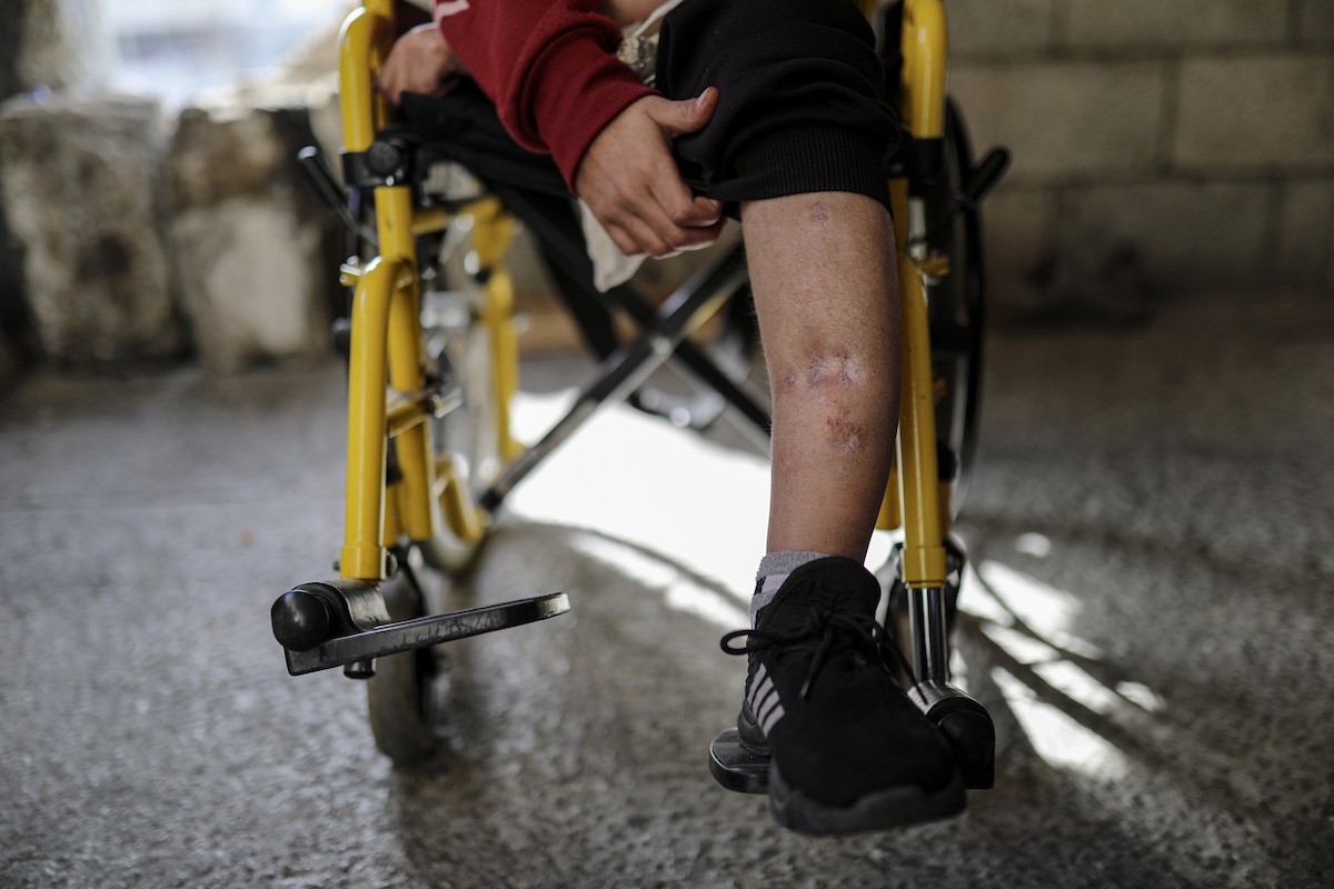 الطفل الفلسطيني محمد المبيض، البالغ من العمر ١٢ عامًا، والذي فقد ساقه في هجوم إسرائيلي على حي الزيتون بغزة (2).jpg