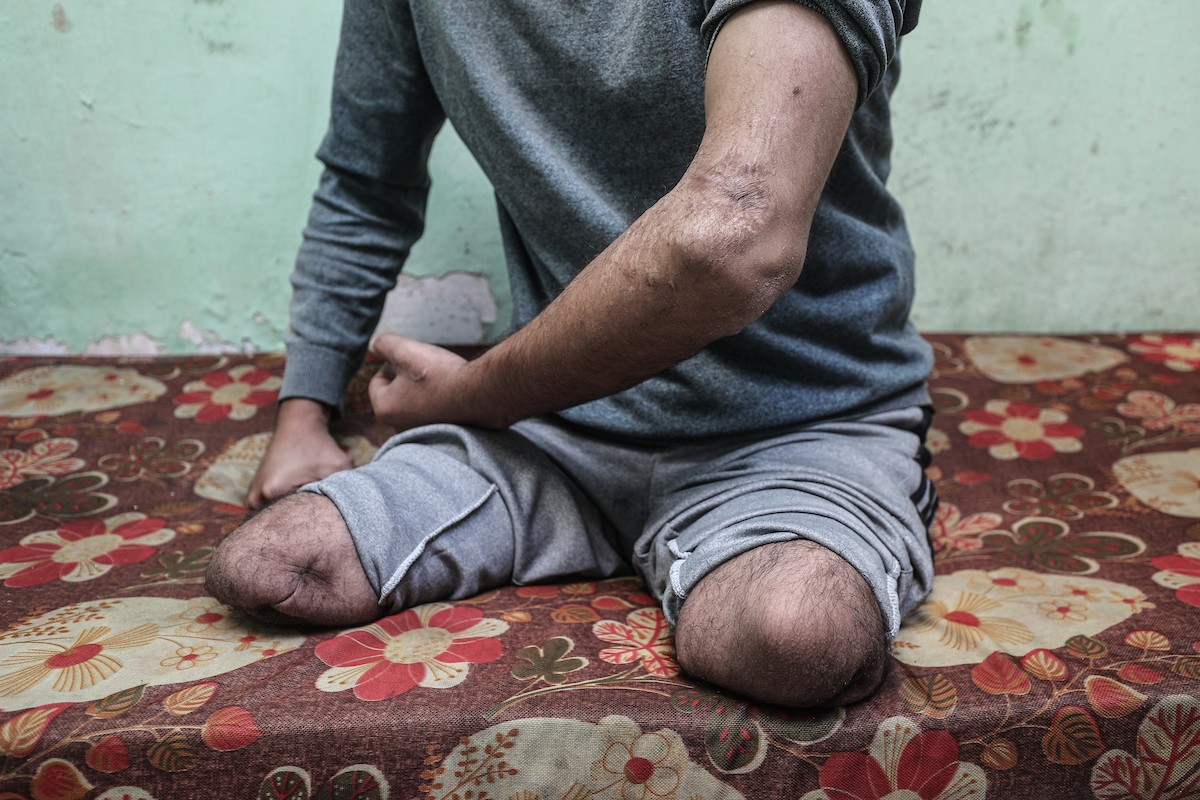  المعلّم سعيد خليل عزم (33 عامًا) أُصيب بجروح بالغة أدّت إلى بتر قدميه، جراء قصف إسرائيلي خلال الحرب على غزة، في مخيم البريج وسط القطاع،  يناير/كانون الثاني 2026. تصوير: معز صالحي