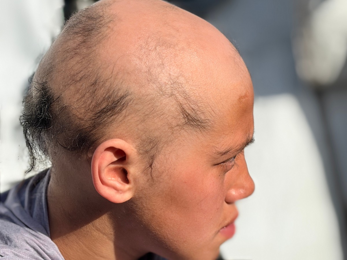 الطفلة لما أبو مطيير (15 عاما)، تعاني من تساقط كامل للشعر بسبب داء الثعلبة الذي اصابها نتيجة الظروف الإنسانية الصعبة ونقص الرعاية الصحية المتوفرة في مخيم الشاطئ للاجئين غرب مدينة غزة ، 9 فبراير/شباط 2026. تصوير: محمد الأسود