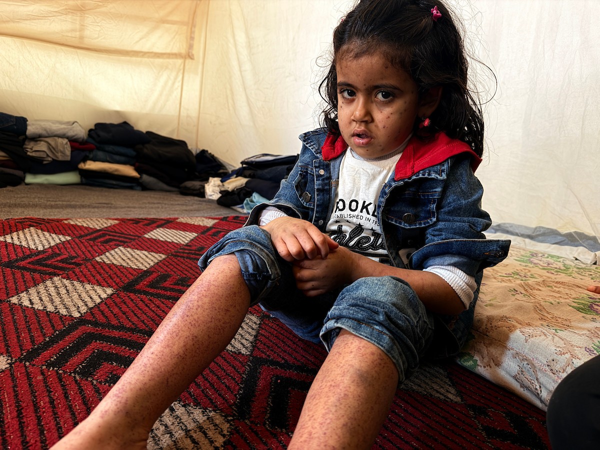 الطفلة الفلسطينية مريم دياب، 5 سنوات، تعيش مع عائلتها داخل خيمة للنازحين أسفل منزل مدمر جراء القصف في حي النصر بمدينة غزة. تعاني مريم من فشل نخاع العظم ونقص حاد في الصفائح الدموية، وهي تنتظر نقلها إلى الخارج لإجراء عملية زرع نخاع عظم قد تنقذ حياتها، 15 فبراير/شباط 2026. تصوير: محمد الأسود.