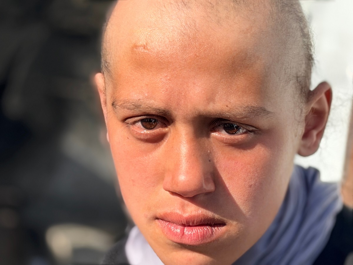 الطفلة لما أبو مطيير (15 عاما)، تعاني من تساقط كامل للشعر بسبب داء الثعلبة الذي اصابها نتيجة الظروف الإنسانية الصعبة ونقص الرعاية الصحية المتوفرة في مخيم الشاطئ للاجئين غرب مدينة غزة ، 9 فبراير/شباط 2026. تصوير: محمد الأسود