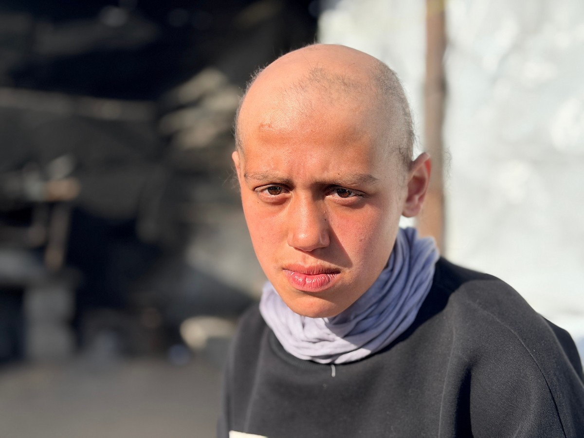 الطفلة لما أبو مطيير (15 عاما)، تعاني من تساقط كامل للشعر بسبب داء الثعلبة الذي اصابها نتيجة الظروف الإنسانية الصعبة ونقص الرعاية الصحية المتوفرة في مخيم الشاطئ للاجئين غرب مدينة غزة ، 9 فبراير/شباط 2026. تصوير: محمد الأسود