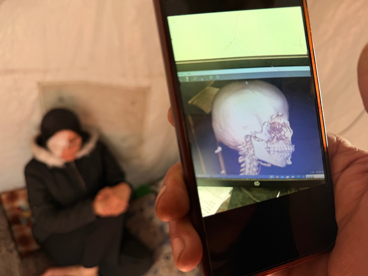 ندى رحومة، طفلة (16 عامًا) نازحة بمنطقة الزوايدة وسط القطاع، ُأصيبت في غارة إسرائيلية قرب خيمة عائلتها في مدينة غزة وفقدت إحدى عينيها، وهي مُعرّضة لخطر فقدان البصر في العين الأخرى إذا لم تتلقَّ علاجًا طبيًا عاجلًا، 10 فبراير/شباط 2026. تصوير: محمد الأسود