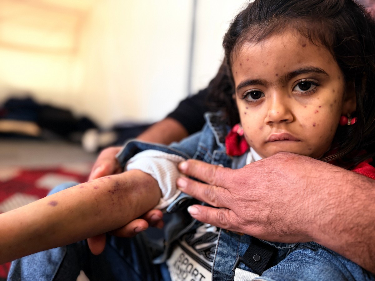 الطفلة الفلسطينية مريم دياب، 5 سنوات، تعيش مع عائلتها داخل خيمة للنازحين أسفل منزل مدمر جراء القصف في حي النصر بمدينة غزة. تعاني مريم من فشل نخاع العظم ونقص حاد في الصفائح الدموية، وهي تنتظر نقلها إلى الخارج لإجراء عملية زرع نخاع عظم قد تنقذ حياتها، 15 فبراير/شباط 2026. تصوير: محمد الأسود.