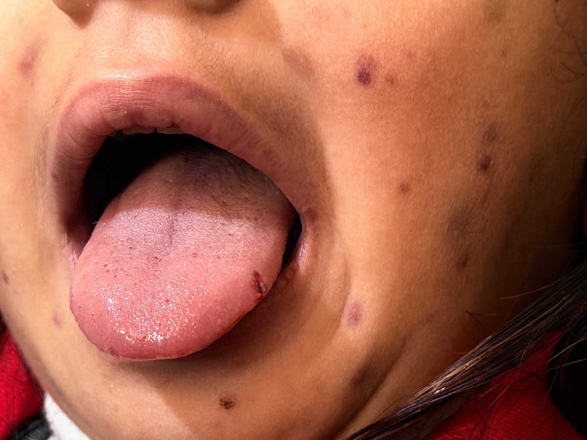 الطفلة الفلسطينية مريم دياب، 5 سنوات، تعيش مع عائلتها داخل خيمة للنازحين أسفل منزل مدمر جراء القصف في حي النصر بمدينة غزة. تعاني مريم من فشل نخاع العظم ونقص حاد في الصفائح الدموية، وهي تنتظر نقلها إلى الخارج لإجراء عملية زرع نخاع عظم قد تنقذ حياتها، 15 فبراير/شباط 2026. تصوير: محمد الأسود.