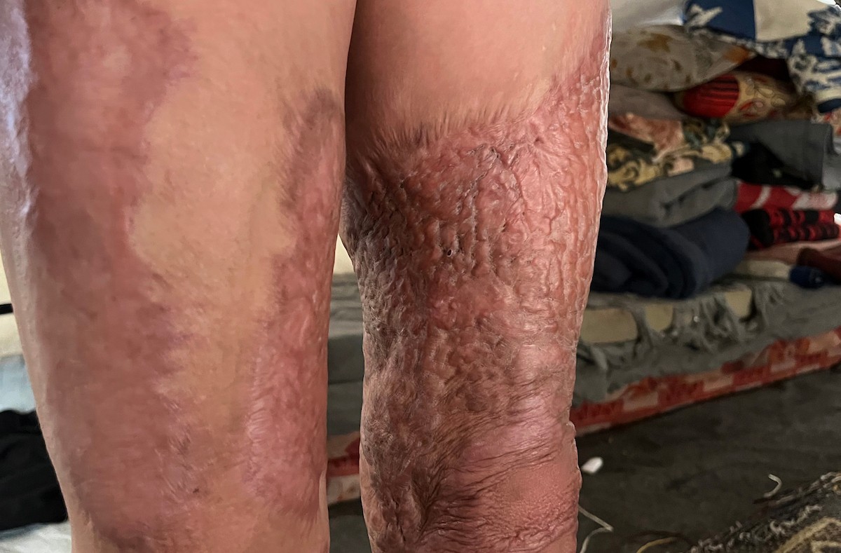 الطفلة رنين جندية مصابة بحروق في جسدها جراء غارة جوية إسرائيلية استهدفت خيمة قرب مخيمها في خان يونس، وتحتاج إلى استكمال العلاج خارج قطاع غزة.مدينة غزة، 1 فبراير/شباط 2026. صورة: مطر الزاق.