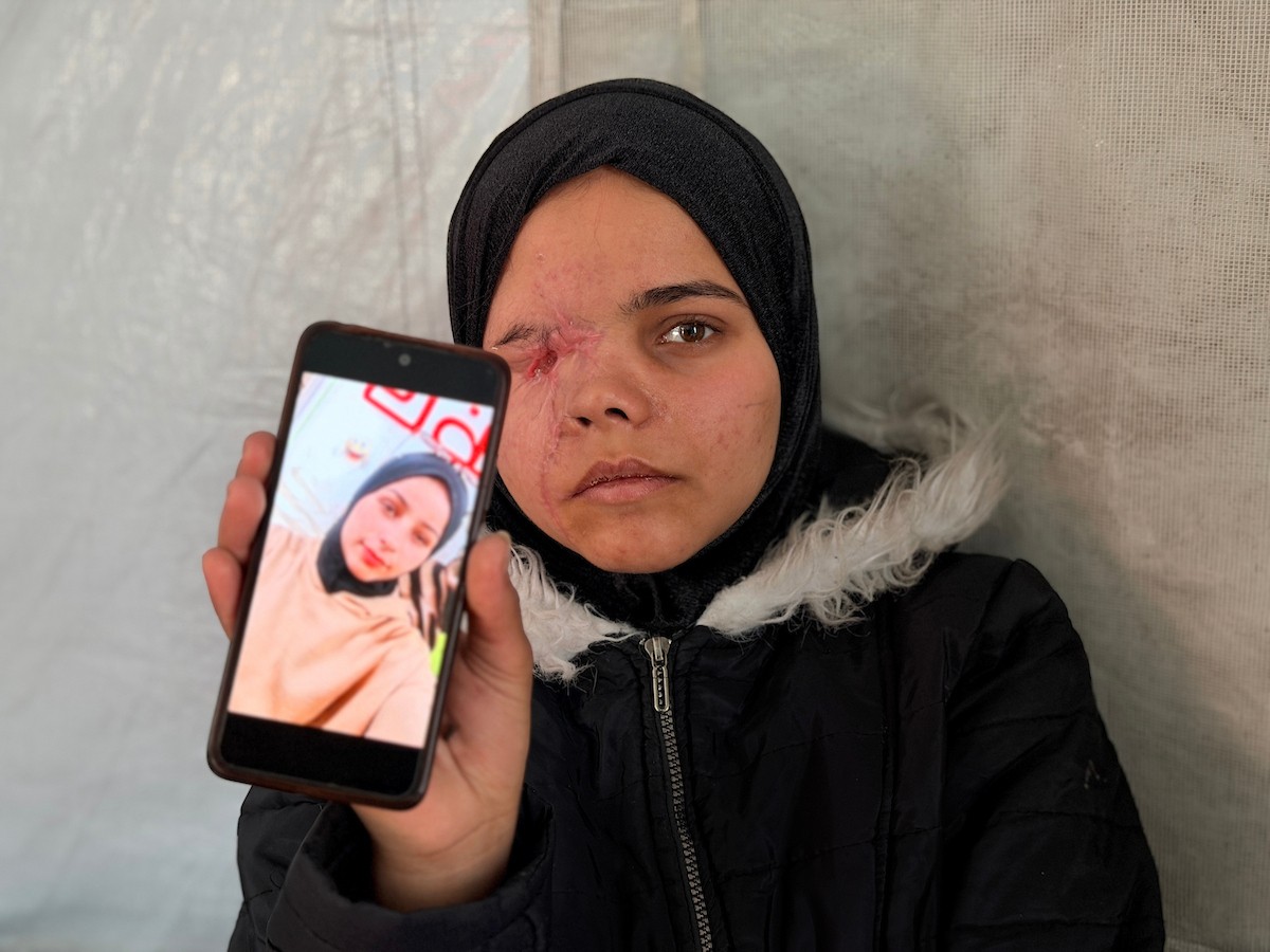 ندى رحومة، طفلة (16 عامًا) نازحة بمنطقة الزوايدة وسط القطاع، ُأصيبت في غارة إسرائيلية قرب خيمة عائلتها في مدينة غزة وفقدت إحدى عينيها، وهي مُعرّضة لخطر فقدان البصر في العين الأخرى إذا لم تتلقَّ علاجًا طبيًا عاجلًا، 10 فبراير/شباط 2026. تصوير: محمد الأسود