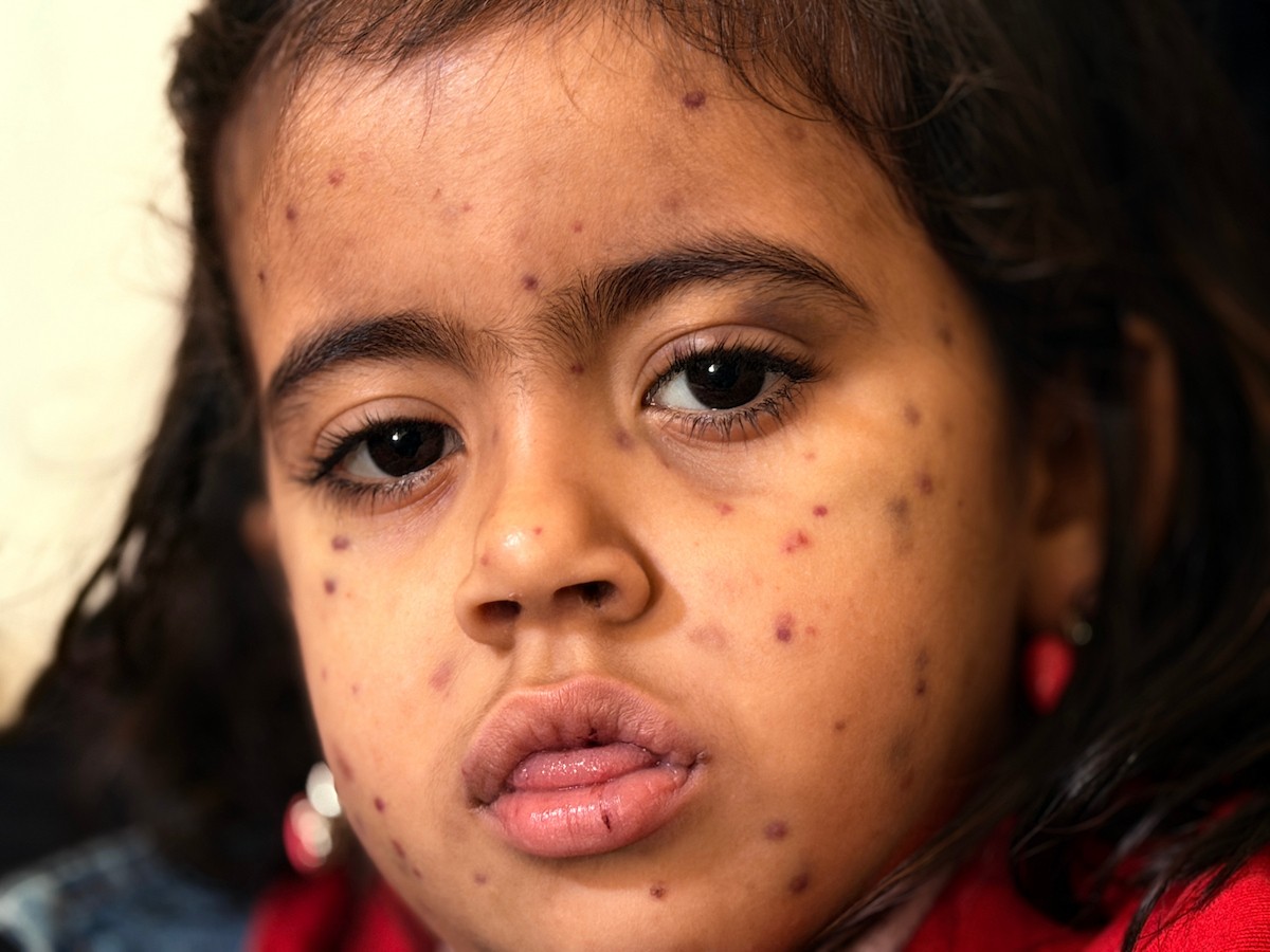 الطفلة الفلسطينية مريم دياب، 5 سنوات، تعيش مع عائلتها داخل خيمة للنازحين أسفل منزل مدمر جراء القصف في حي النصر بمدينة غزة. تعاني مريم من فشل نخاع العظم ونقص حاد في الصفائح الدموية، وهي تنتظر نقلها إلى الخارج لإجراء عملية زرع نخاع عظم قد تنقذ حياتها، 15 فبراير/شباط 2026. تصوير: محمد الأسود.