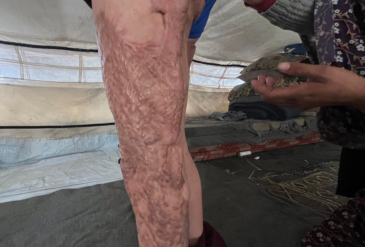 الطفلة رنين جندية مصابة بحروق في جسدها جراء غارة جوية إسرائيلية استهدفت خيمة قرب مخيمها في خان يونس، وتحتاج إلى استكمال العلاج خارج قطاع غزة.مدينة غزة، 1 فبراير/شباط 2026. صورة: مطر الزاق.