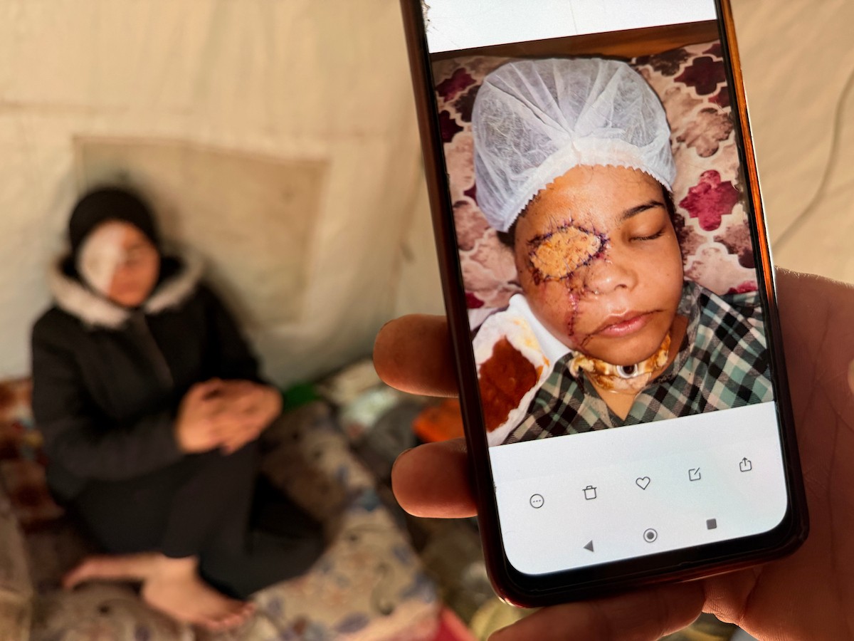 ندى رحومة، طفلة (16 عامًا) نازحة بمنطقة الزوايدة وسط القطاع، ُأصيبت في غارة إسرائيلية قرب خيمة عائلتها في مدينة غزة وفقدت إحدى عينيها، وهي مُعرّضة لخطر فقدان البصر في العين الأخرى إذا لم تتلقَّ علاجًا طبيًا عاجلًا، 10 فبراير/شباط 2026. تصوير: محمد الأسود