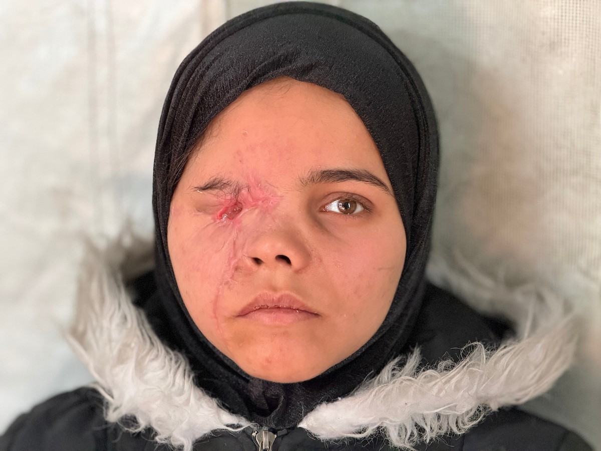 ندى رحومة، طفلة (16 عامًا) نازحة بمنطقة الزوايدة وسط القطاع، ُأصيبت في غارة إسرائيلية قرب خيمة عائلتها في مدينة غزة وفقدت إحدى عينيها، وهي مُعرّضة لخطر فقدان البصر في العين الأخرى إذا لم تتلقَّ علاجًا طبيًا عاجلًا، 10 فبراير/شباط 2026. تصوير: محمد الأسود