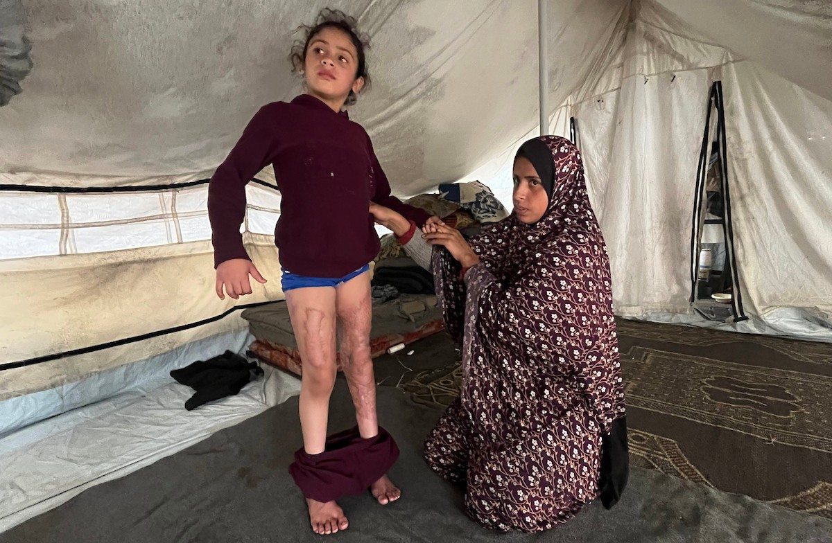 الطفلة رنين جندية مصابة بحروق في جسدها جراء غارة جوية إسرائيلية استهدفت خيمة قرب مخيمها في خان يونس، وتحتاج إلى استكمال العلاج خارج قطاع غزة.مدينة غزة، 1 فبراير/شباط 2026. صورة: مطر الزاق.