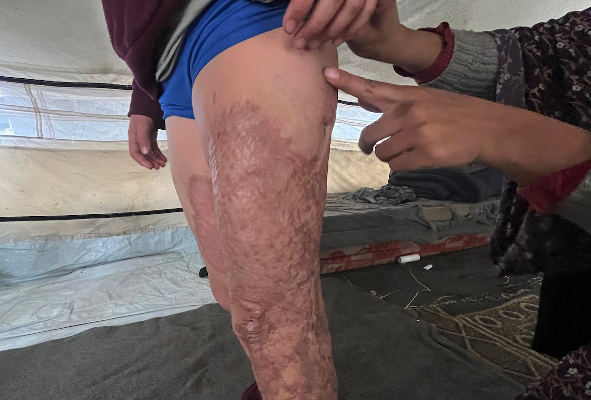 الطفلة رنين جندية مصابة بحروق في جسدها جراء غارة جوية إسرائيلية استهدفت خيمة قرب مخيمها في خان يونس، وتحتاج إلى استكمال العلاج خارج قطاع غزة.مدينة غزة، 1 فبراير/شباط 2026. صورة: مطر الزاق.