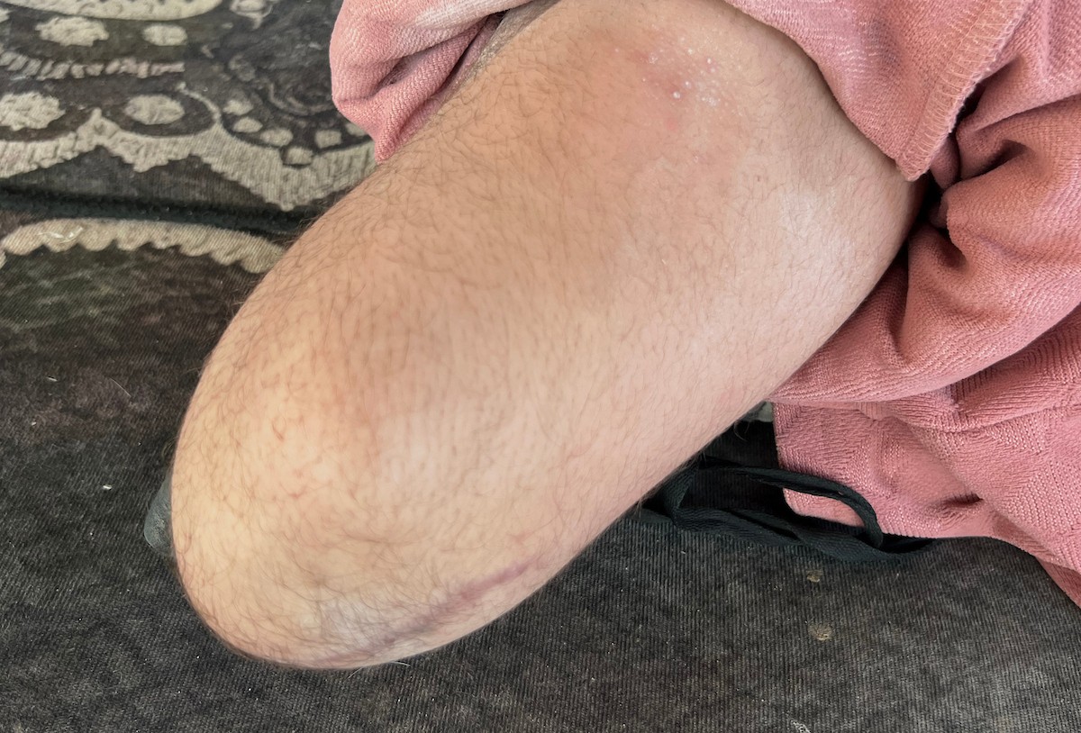 منة وائل عاشور (12 عاماً) وشقيقها فايز (24 عاماً) يعيشان في خيمة نزوح بمدينة دير البلح وسط قطاع غزة، بعد أن فقدا أطرافهما جراء هجوم إسرائيلي قبل نحو تسعة أشهر، 16 أبريل/نيسان 2026. صورة: يوسف أبو طفة