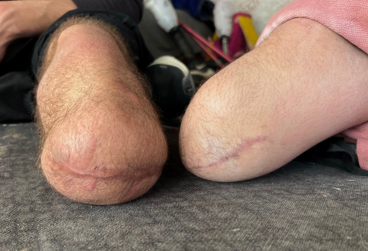 منة وائل عاشور (12 عاماً) وشقيقها فايز (24 عاماً) يعيشان في خيمة نزوح بمدينة دير البلح وسط قطاع غزة، بعد أن فقدا أطرافهما جراء هجوم إسرائيلي قبل نحو تسعة أشهر، 16 أبريل/نيسان 2026. صورة: يوسف أبو طفة