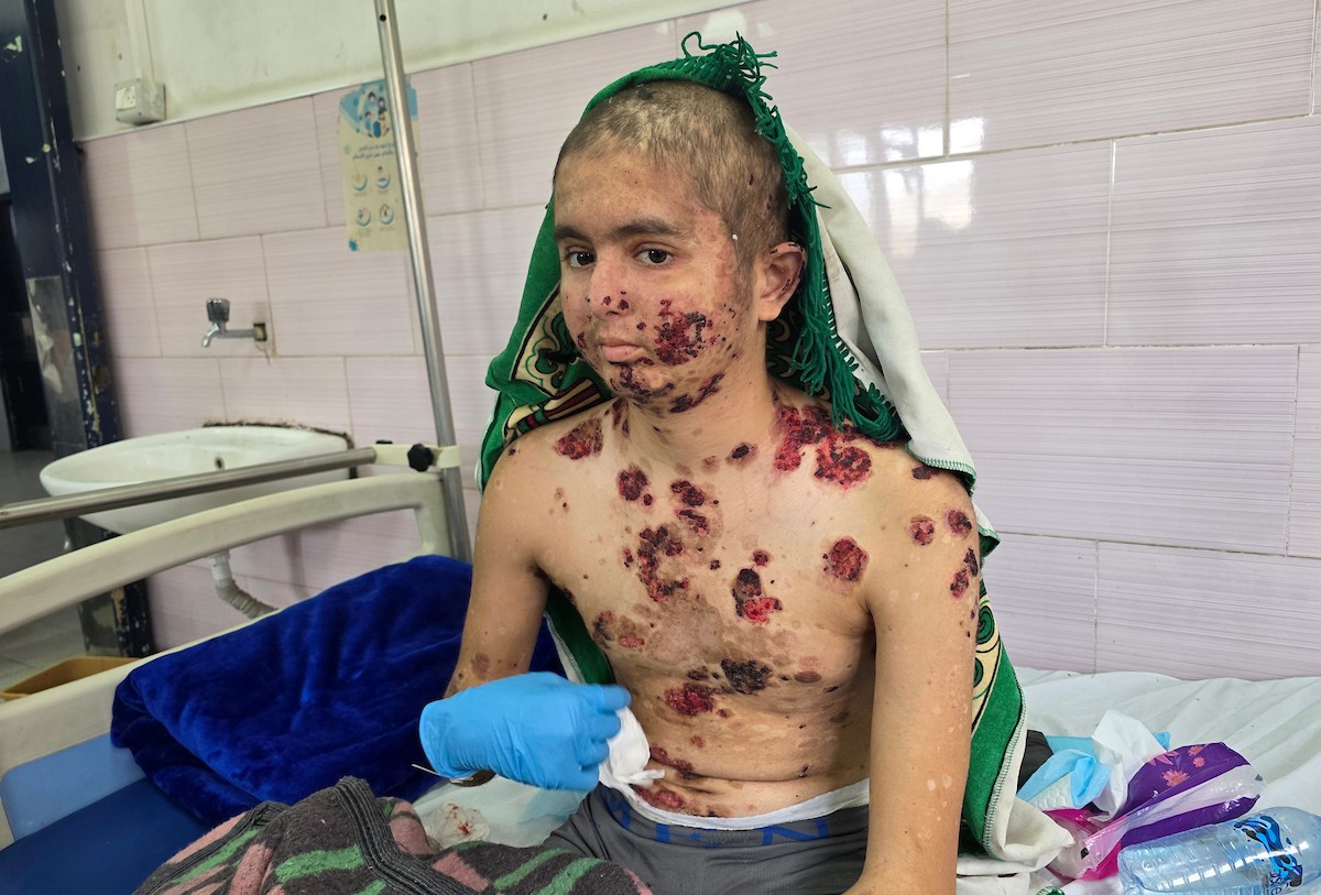 عبد الله الرقب يتلقى العلاج في مستشفى ناصر بخان يونس، جنوب قطاع غزة، في 2 مايو/أيار 2026.