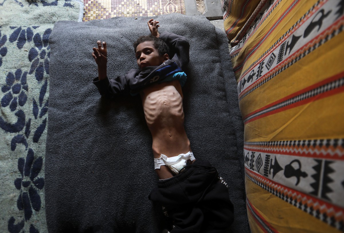 الطفل الفلسطيني محمد أحمد مسعود السوسي، 10 أعوام، داخل خيمة في مدينة غزة، في 6 مايو/أيار 2026، حيث يعاني من سوء التغذية ويحتاج إلى علاج طبي عاجل. تصوير: بلال أسامة