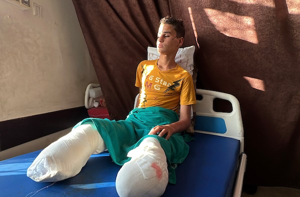 الطفل محمد سرور يتلقى العلاج في مستشفى شهداء الأقصى بدير البلح، وسط قطاع غزة، في 2 يونيو/حزيران 2026، بعد إصابته بانفجار جسم من مخلفات الجيش الإسرائيلي خلال الحرب، ما أدى إلى بتر قدميه وفقدان عينه اليسرى وإصابته بشلل في يده اليسرى.  تصوير: يوسف أبو وطفة