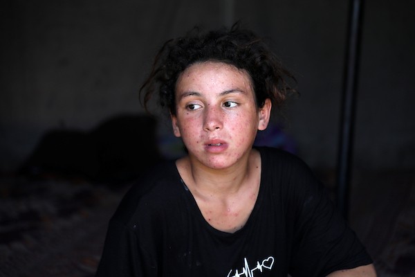 الفتاة الفلسطينية أشجان السوسي داخل خيمة تؤوي أسرتها النازحة غرب مدينة غزة، حيث تعاني من مرض جلدي تفاقم بفعل الحرّ وظروف النزوح القاسية. تصوير: بلال أسامة