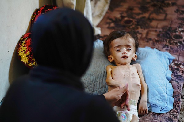 الرضيع عصام النبيه، يتلقى الرعاية من عائلته داخل مأوى مؤقت في مدينة غزة، في 10 يوليو/تموز 2026، بينما يعاني من سوء تغذية حاد واستسقاء دماغي، ويتعذر نقله للعلاج خارج القطاع. تصوير: محمد أبو القمصان