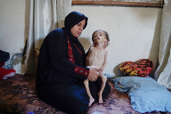 الرضيع عصام النبيه، يتلقى الرعاية من عائلته داخل مأوى مؤقت في مدينة غزة، في 10 يوليو/تموز 2026، بينما يعاني من سوء تغذية حاد واستسقاء دماغي، ويتعذر نقله للعلاج خارج القطاع. تصوير: محمد أبو القمصان