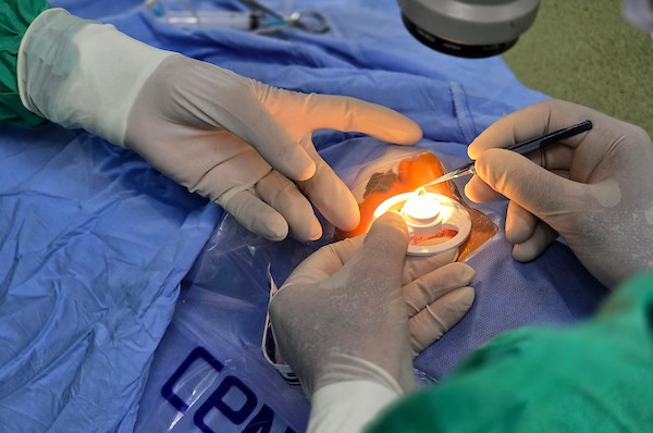 عملية زرع قرنية لفتاة تبلغ من العمر 12 عامًا في مجمع ناصر الطبي بخان يونس جنوب قطاع غزة، في 21 يوليو/تموز 2026.(صورة: طارق محمد)