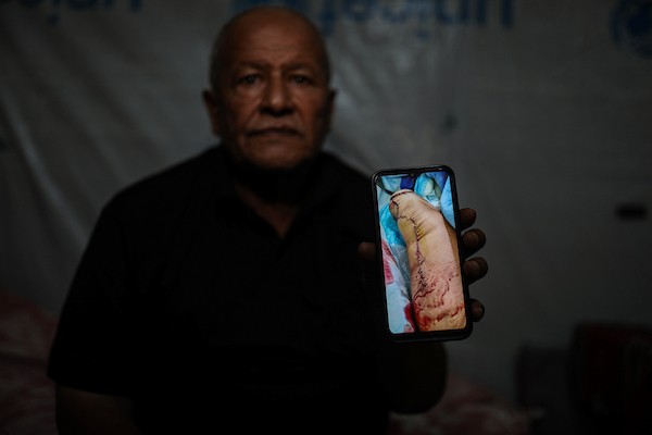 محمود فؤاد الدهشان (64 عامًا) يستعين بجهاز طبي للمشي في حي الزيتون بمدينة غزة، بعد فقدان قدمه اليسرى في قصف إسرائيلي عام 2023. (تصوير: بلال أسامة)